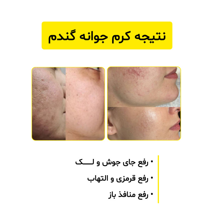 تاثیر کرم جوانه گندم ویتابلا بر درمان لکهای صورت، بهبود ککومک و شفافسازی پوست کدر