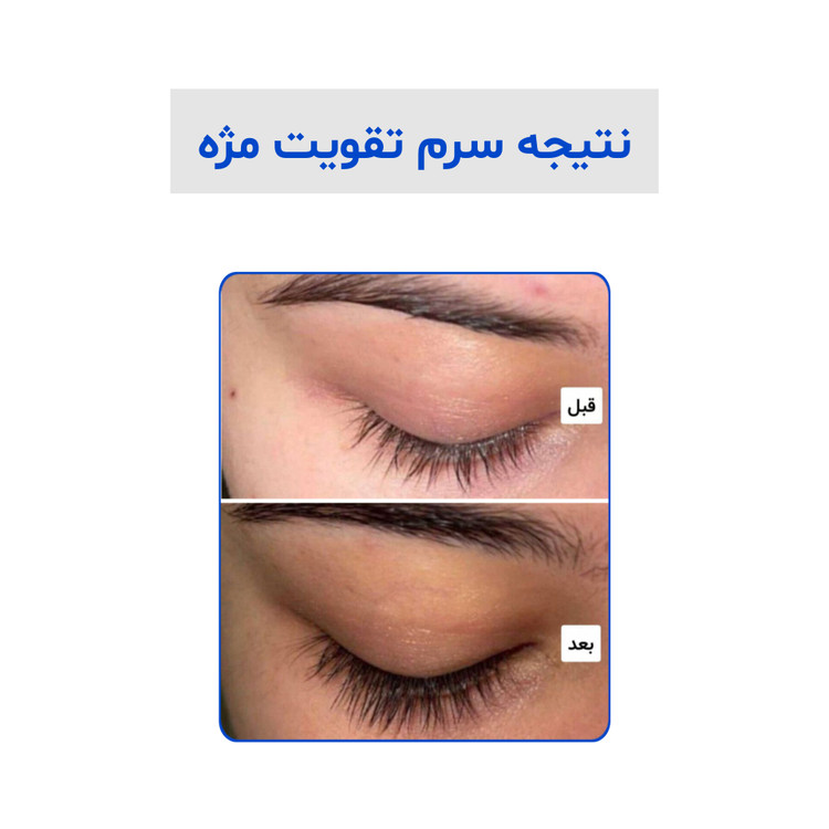 عکس قبل و بعد استفاده از سرم مژه لاکچری کوین