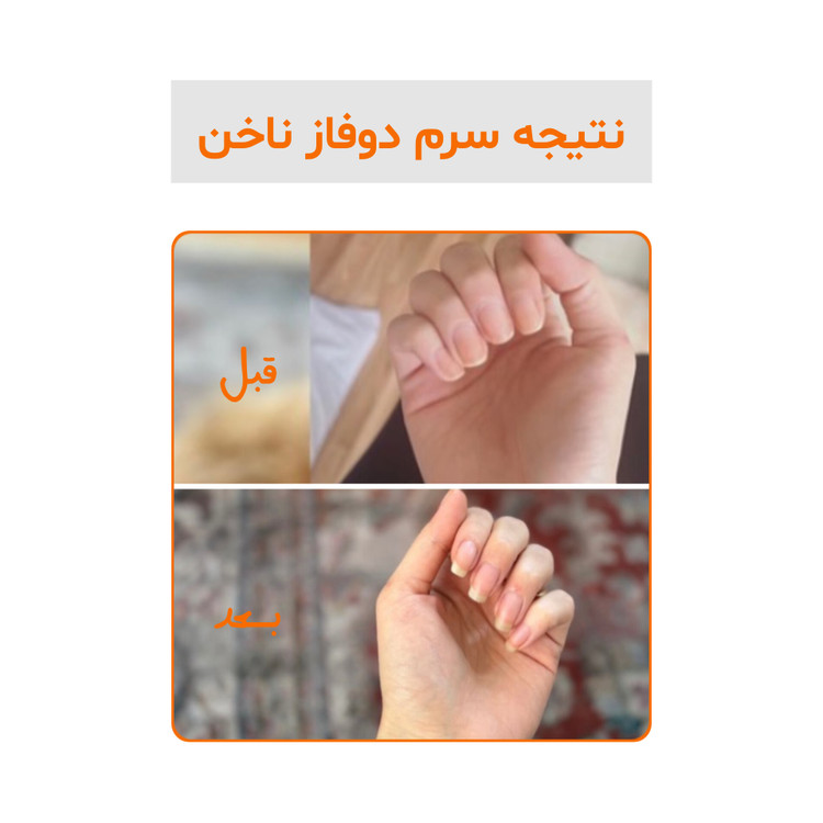 بازسازی ناخنهای آسیبدیده؛ نتایج استفاده از سرم دوفاز ویتابلا در یک نگاه