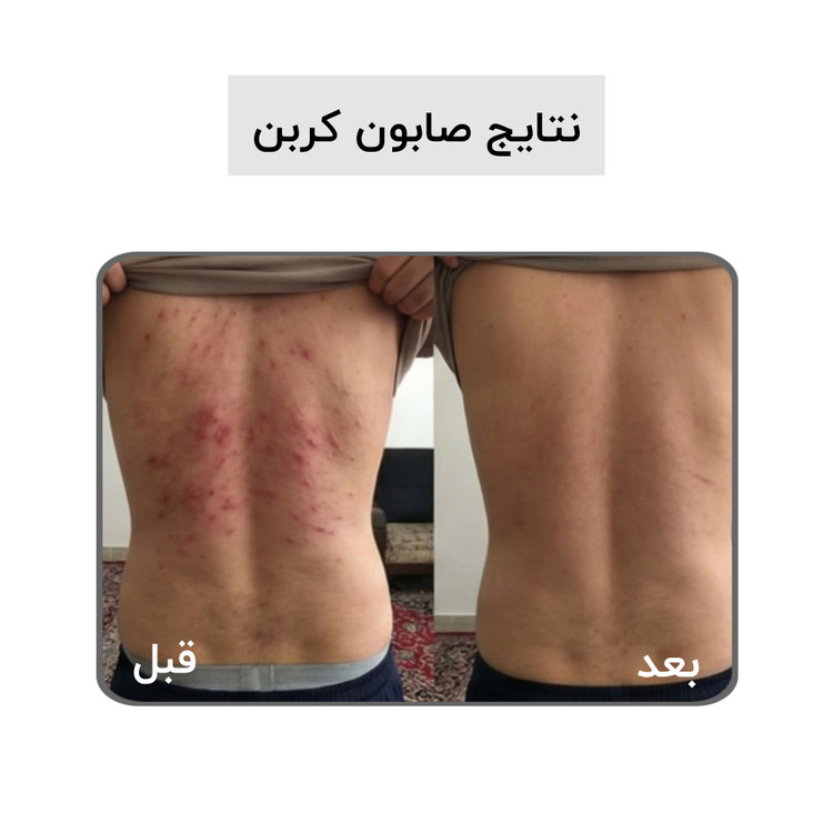 صابون کربن فعال بیز؛ ضد جوش٫ضد لک٫روشن کننده
