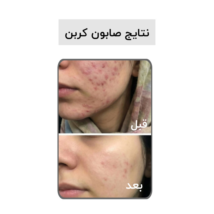 صابون کربن فعال بیز؛ ضد جوش٫ضد لک٫روشن کننده