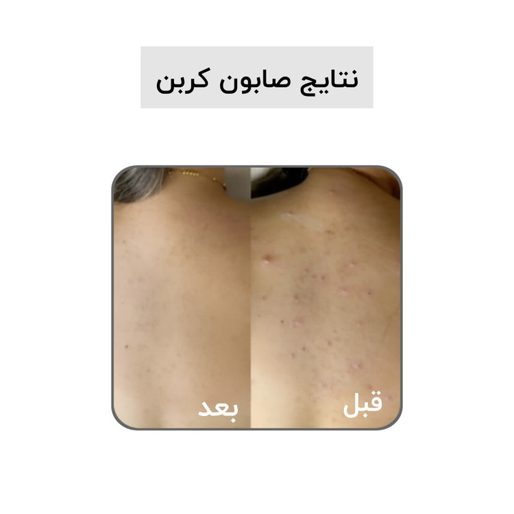 صابون کربن فعال بیز؛ ضد جوش٫ضد لک٫روشن کننده