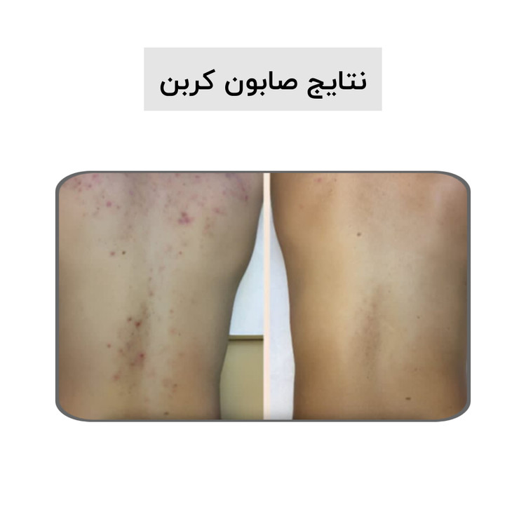 صابون کربن فعال بیز؛ ضد جوش٫ضد لک٫روشن کننده