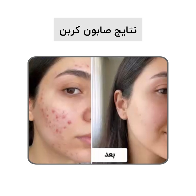 صابون کربن فعال بیز؛ ضد جوش٫ضد لک٫روشن کننده