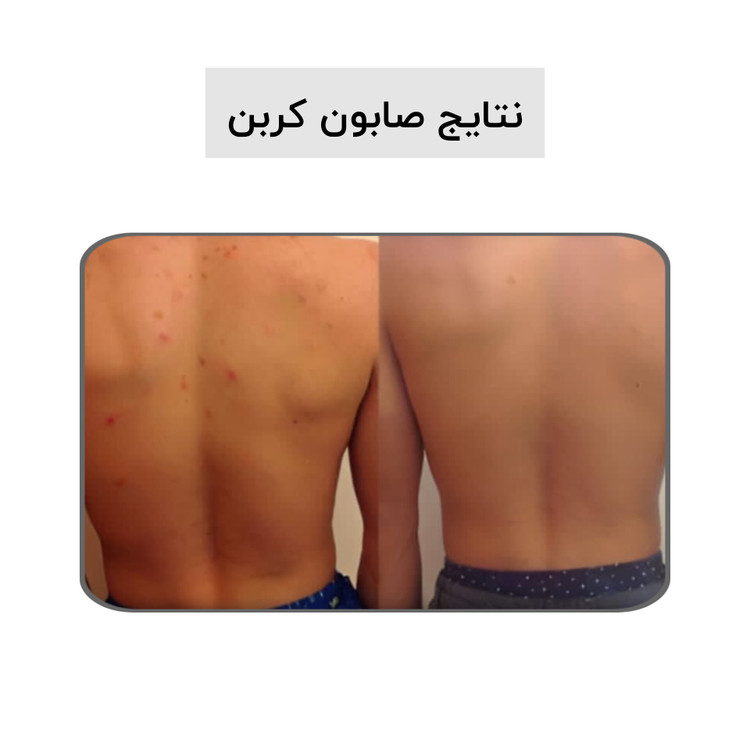 صابون کربن فعال بیز؛ ضد جوش٫ضد لک٫روشن کننده