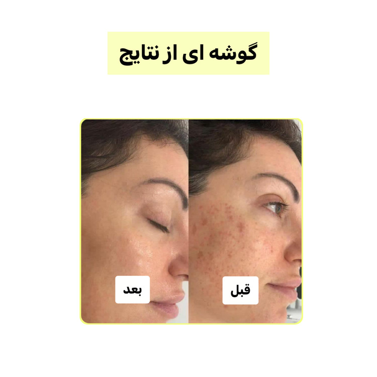 پک چندکاره کربن فعال (لایهبردار، روشنکننده و ضدجوش) | اصل