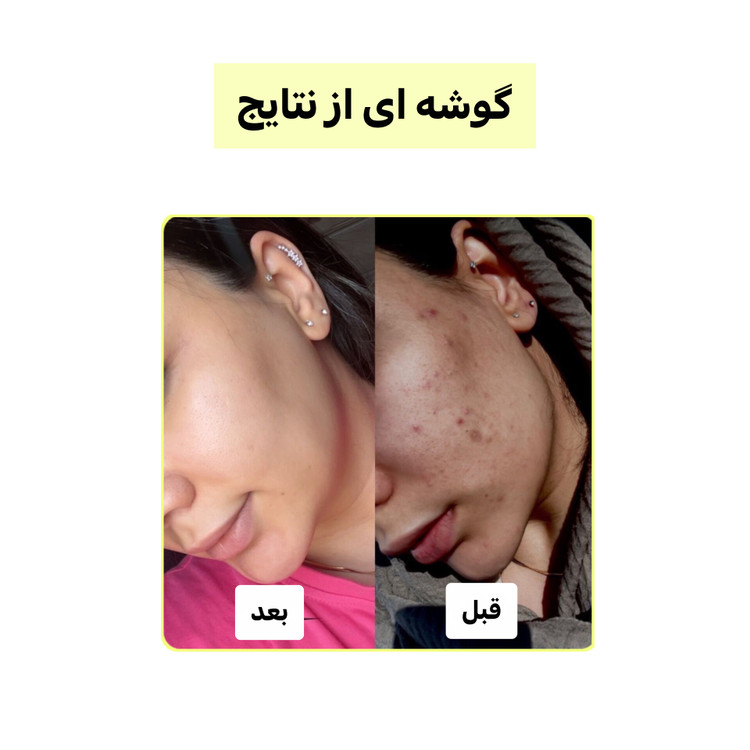 پک چندکاره کربن فعال (لایهبردار، روشنکننده و ضدجوش) | اصل