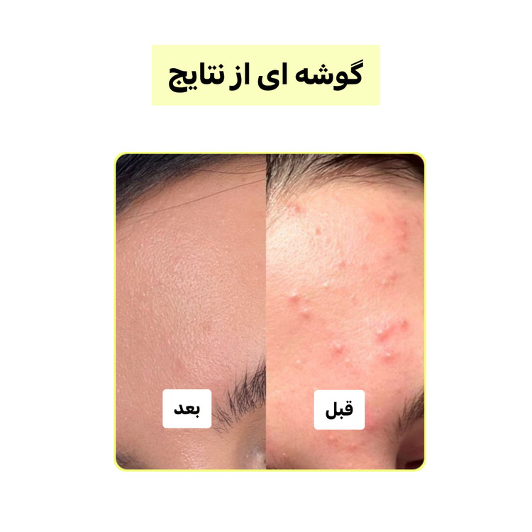 پک چندکاره کربن فعال (لایهبردار، روشنکننده و ضدجوش) | اصل