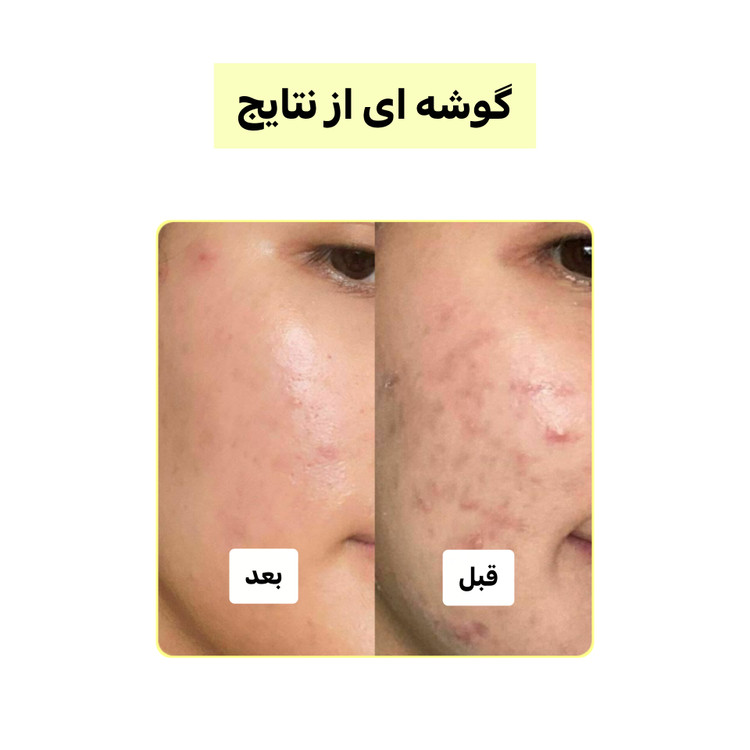 پک چندکاره کربن فعال (لایهبردار، روشنکننده و ضدجوش) | اصل