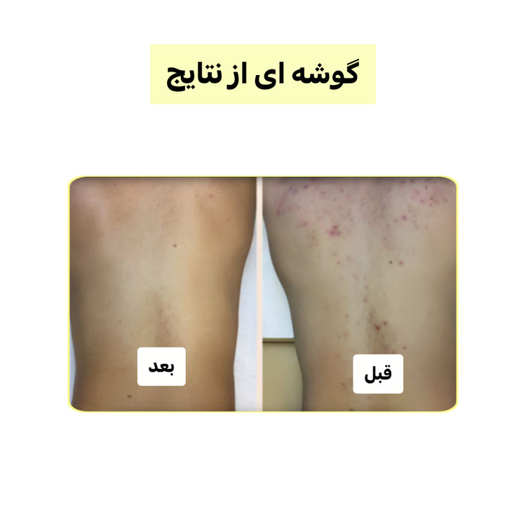 پک چندکاره کربن فعال (لایهبردار، روشنکننده و ضدجوش) | اصل