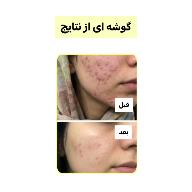 پک چندکاره کربن فعال (لایهبردار، روشنکننده و ضدجوش) | اصل
