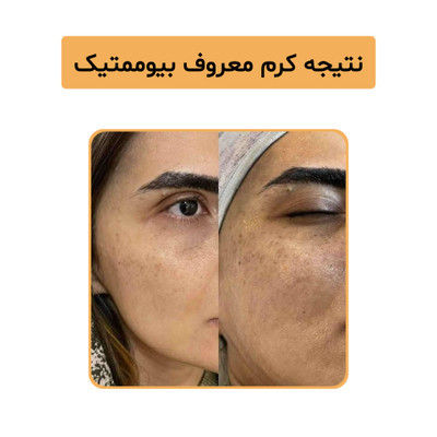 پک بیوممتیک ضد لک و روشن کننده صورت گاتیو