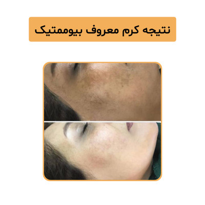 پک بیوممتیک ضد لک و روشن کننده صورت گاتیو